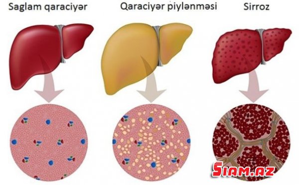 Tibbdə yenilik: Qara ciyərin bərpası artıq mümkün olacaq